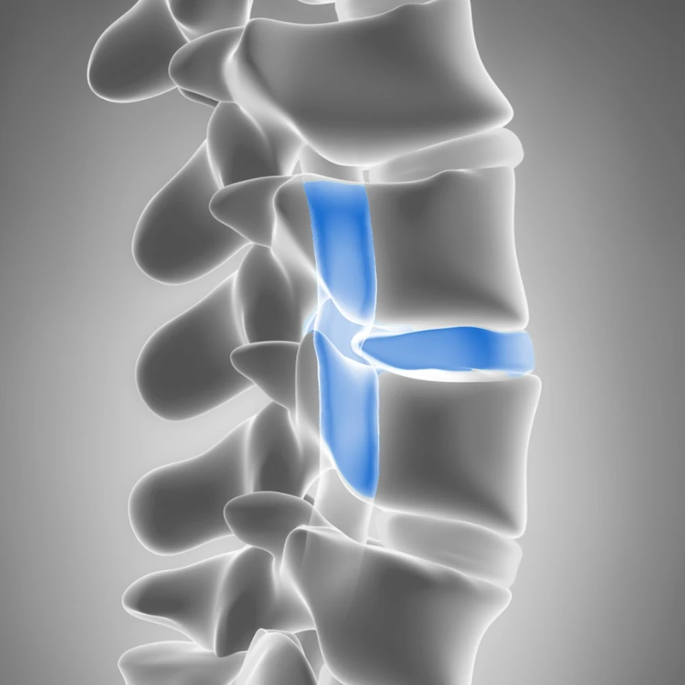 A decompressed disc space between two vertebrae